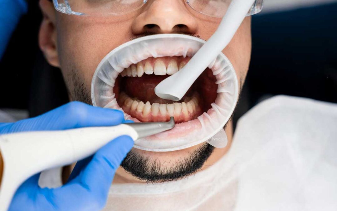 AirFlow para dentes sensíveis: é possível fazer limpeza sem sofrer?