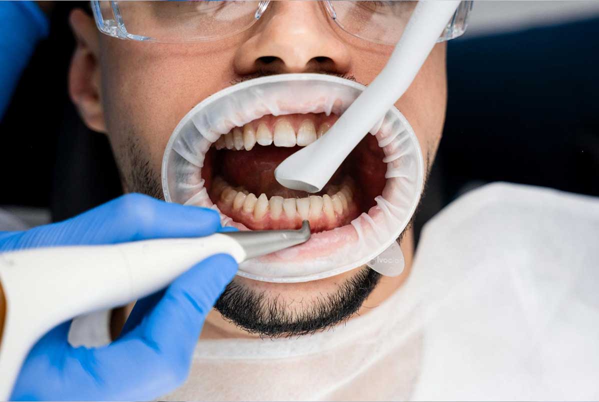AirFlow para dentes sensíveis: é possível fazer limpeza sem sofrer?