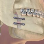 Cirurgia ortognática: ainda é necessária ou existem alternativas menos invasivas?