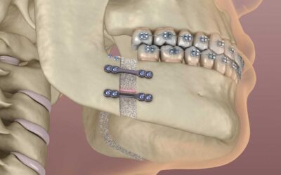 Cirurgia ortognática: ainda é necessária ou existem alternativas menos invasivas?