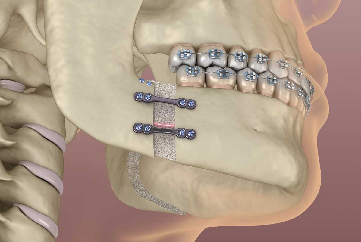 Cirurgia ortognática: ainda é necessária ou existem alternativas menos invasivas?