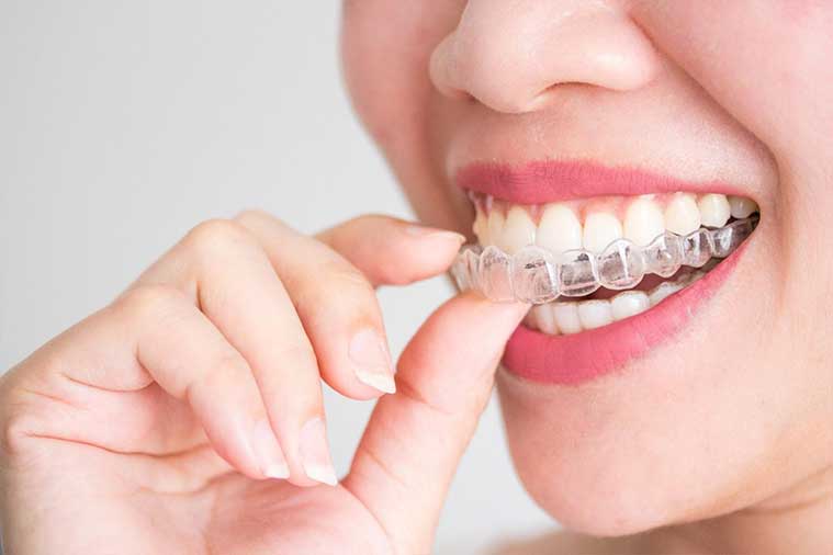 Como funciona o tratamento com Invisalign?<br />
