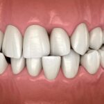 Dentes tortos afetam a saúde? Entenda além da estética