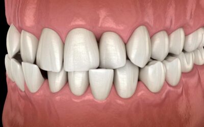 Dentes tortos afetam a saúde? Entenda além da estética