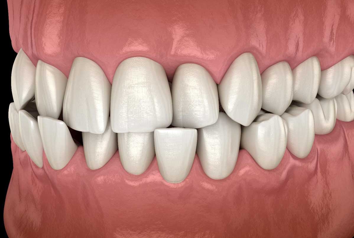 Dentes tortos afetam a saúde? Entenda além da estética