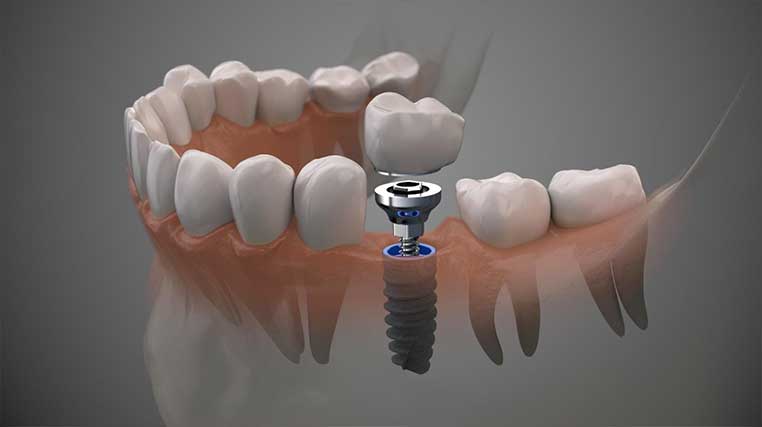 Implantes e próteses: recuperar função, segurança e autoestima<br />
