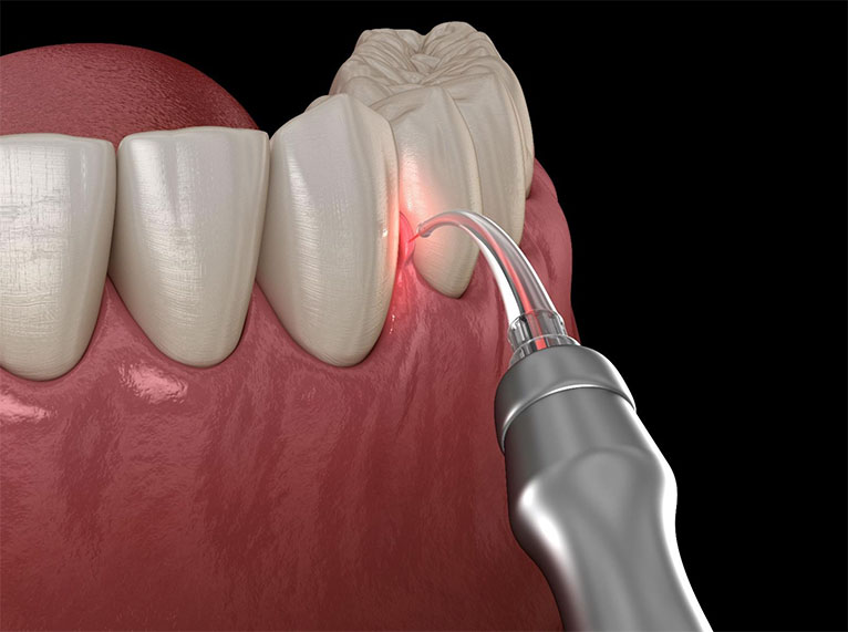 Laser de baixa potência: mais conforto e melhor recuperação<br />
