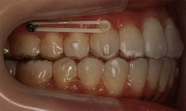 Mini-implantes ortodônticos: ancoragem de alta precisão</p>
<p>