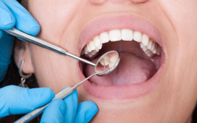 Por que a limpeza dental (profilaxia) é importante para quem tem diabetes?